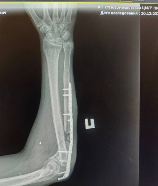 Драка с ветераном 25 ОПДБр — рентген руки Ямахи после ранения