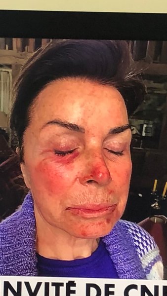 бернар тапи, доминик тапи