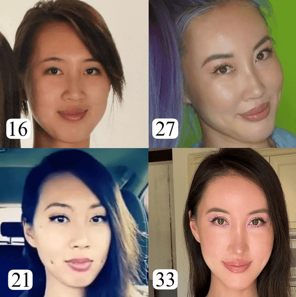 Последствия пластики на лице, до и после