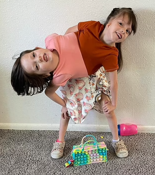 Біографія сіамських близнючок Келлі та Картер із США, унікальні діти, аномалії, операція, курйози, дивовижні історії, фото