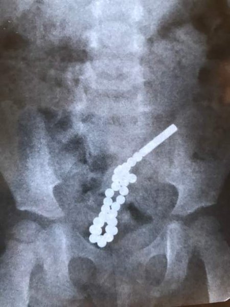 рентген, снимок, кишечник, ребенок, магниты, шарики