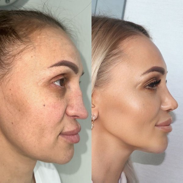 Женщину после пластической операции невозможно узнать, кардинальные изменения во внешности, фото до и после пластики