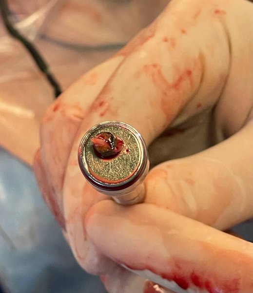 хирурги, осколок из сердца