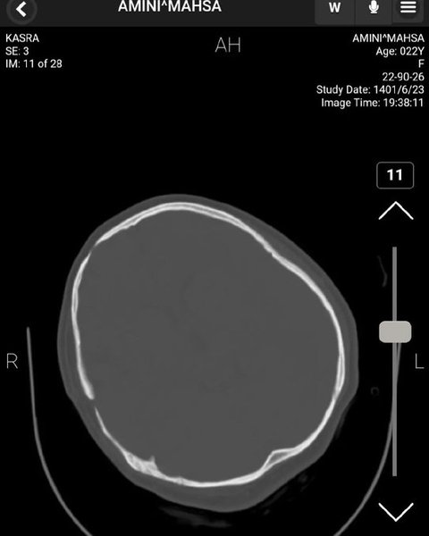 черепно-мозкова травма, Махса Аміні