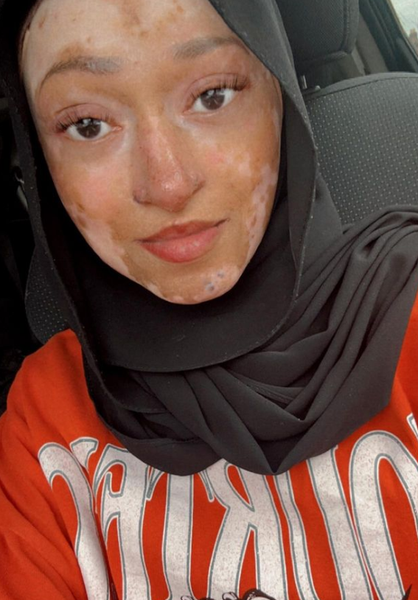 Захворювання шкіри, аномалії, дивні діагнози, зовнішність як Фредді Крюгера, фото, Велика Британія