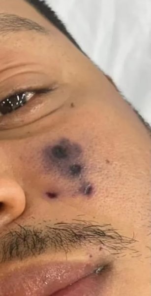 Дарлин Мораис, укус паука, больница