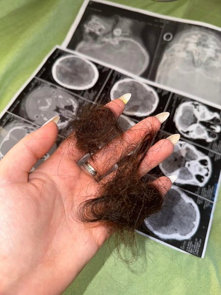 волосся, постраждала