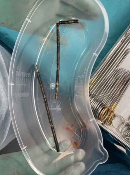 магниты в кишечнике