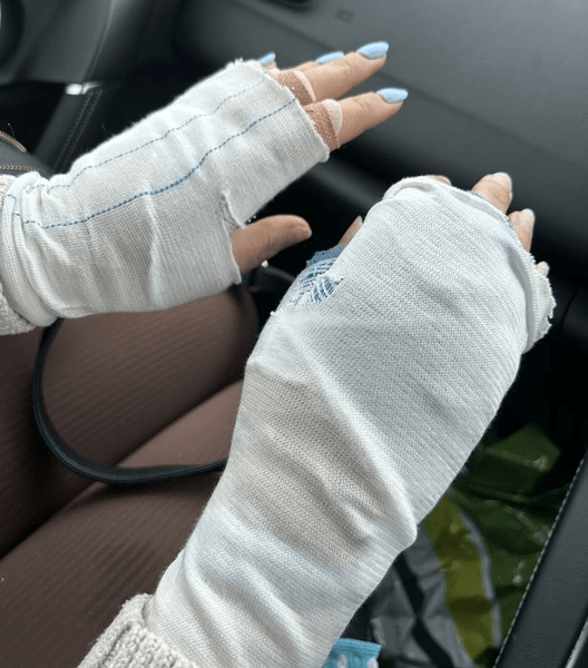 Опік руки, руки, британка, торкнулася отруйної рослини, перервала відпустку, потрапила до лікарні, пухирі на руках, опік