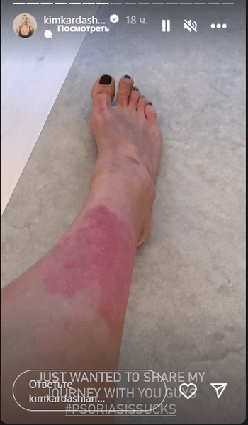Псориаз у Ким Кардашьян