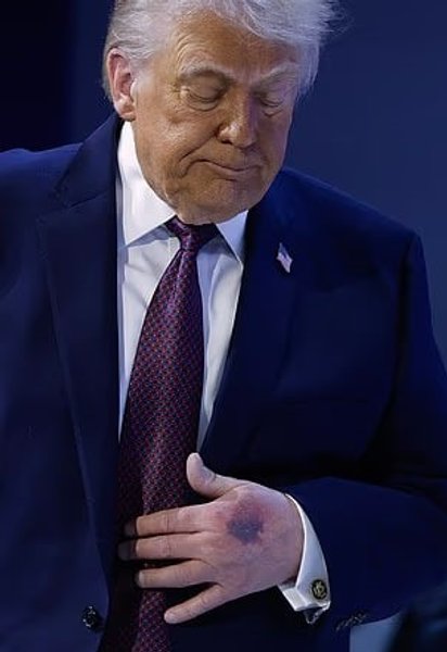 Здоров'я Трампа - на його шиї та руках помітили синці - фото На руках Дональда Трампа журналісти зафіксували синці