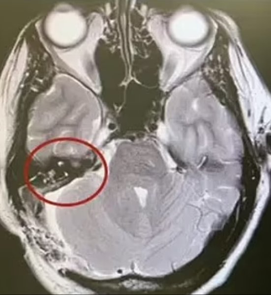 опухоль мозга