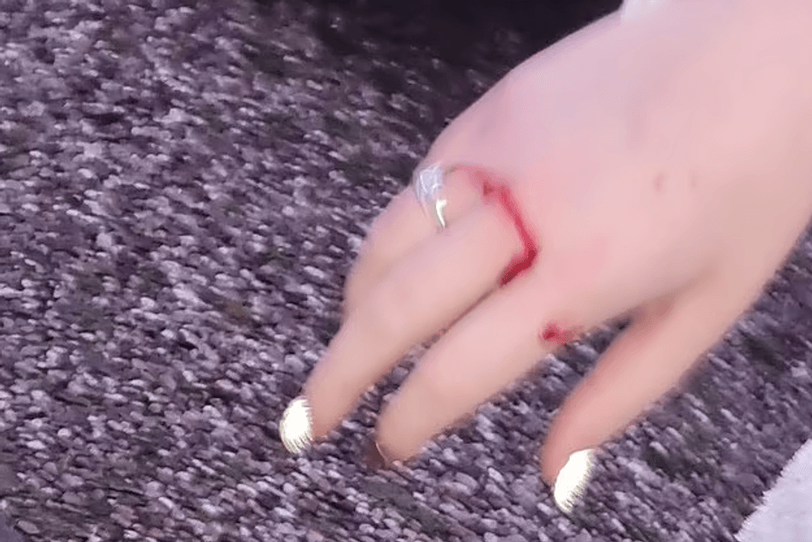 Рука женщины после нападения Полоски