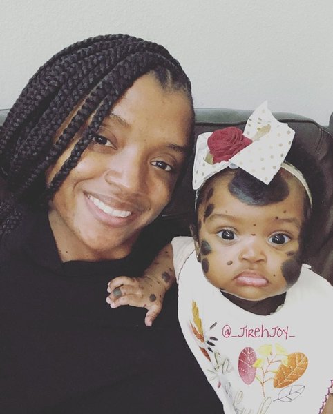 девочка с пятнами на лице, невус