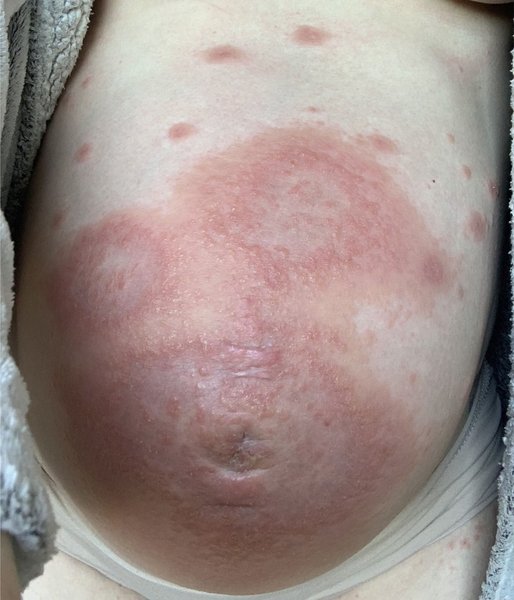 Пемфігоїд, алергія, алергія у вагітних, алергія на дитину