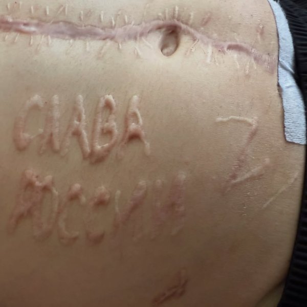 Шрамы на военнопленном