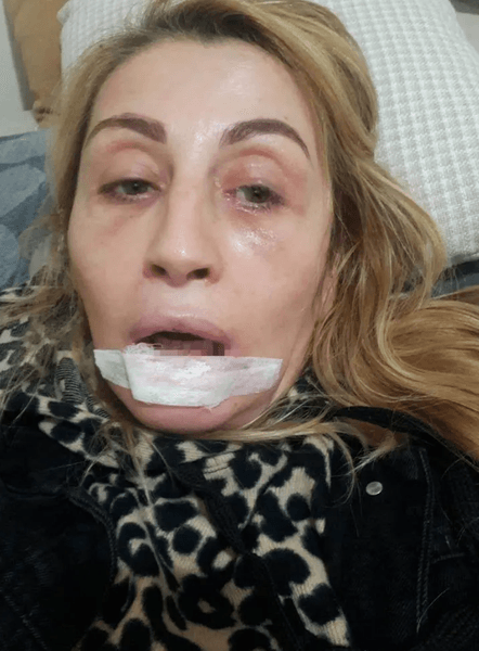 Сонгюль Узуноглу подала в суд из-за неудачной пластической операции