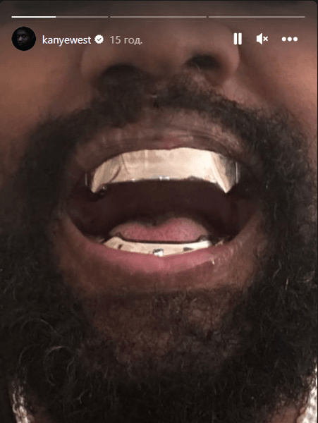Канье Уэст, титановые зубы