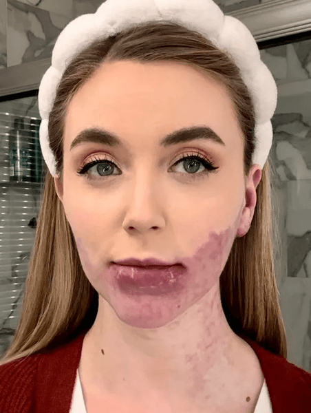 Девушка перенесла 20 операций, родимое пятно, аномалия на лице, редкая болезнь, кровеносные сосуды, пятно на лице, операция